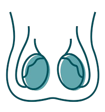 Hydrocele